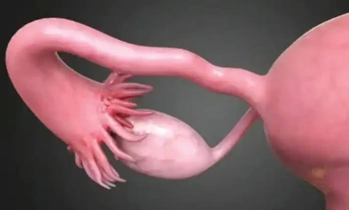 مینوپاز